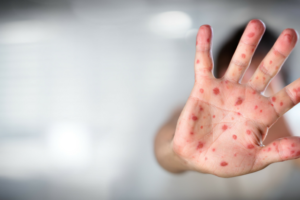 Understanding Chickenpox Symptoms in Summer: What You Need to Know