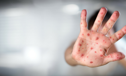 Understanding Chickenpox Symptoms in Summer: What You Need to Know