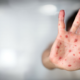 Understanding Chickenpox Symptoms in Summer: What You Need to Know