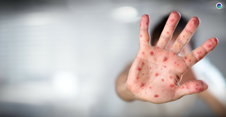 Understanding Chickenpox Symptoms in Summer: What You Need to Know